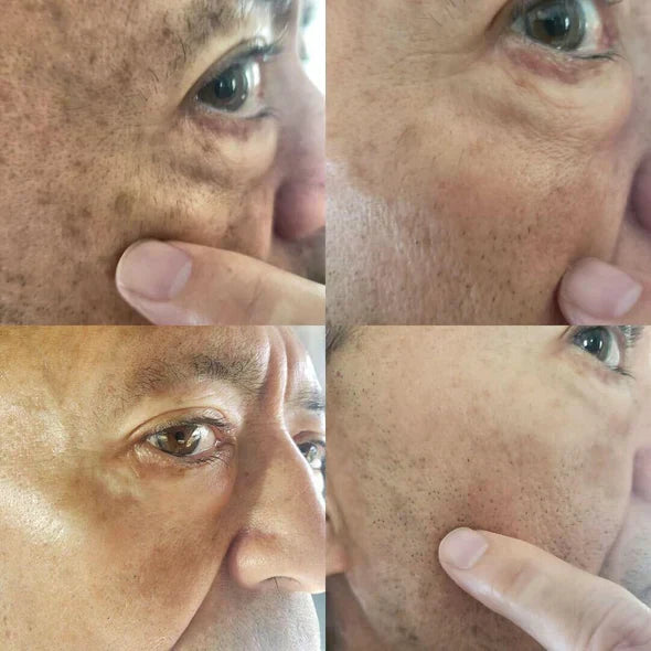 ✨Fast Dark Spot Remover-Peachlife™  Melanin Correcting Facial Serum(🔥Last Day Promotion 60% OFF)