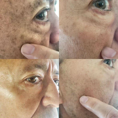 ✨Fast Dark Spot Remover-Peachlife™  Melanin Correcting Facial Serum(🔥Last Day Promotion 60% OFF)