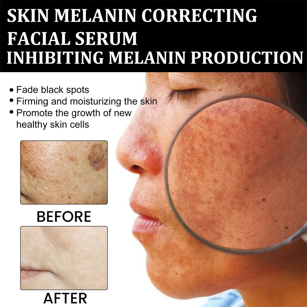 ✨Fast Dark Spot Remover-Peachlife™  Melanin Correcting Facial Serum(🔥Last Day Promotion 60% OFF)
