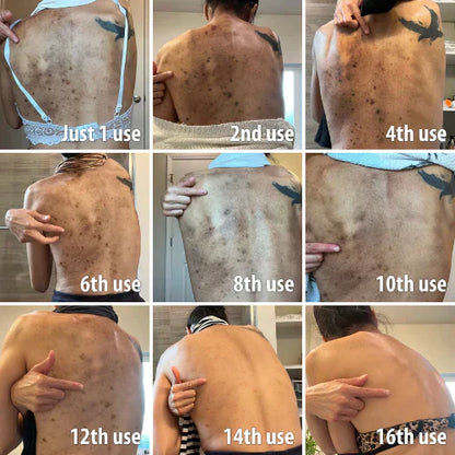 ✨Fast Dark Spot Remover-Peachlife™  Melanin Correcting Facial Serum(🔥Last Day Promotion 60% OFF)