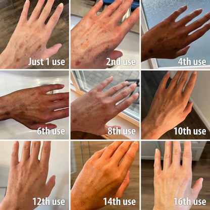 ✨Fast Dark Spot Remover-Peachlife™  Melanin Correcting Facial Serum(🔥Last Day Promotion 60% OFF)