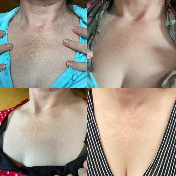 ✨Fast Dark Spot Remover-Peachlife™  Melanin Correcting Facial Serum(🔥Last Day Promotion 60% OFF)